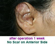 plastic-surgery-prominent-ear 